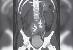 Мъж откри, че има три бъбрека