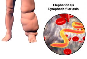 Чували ли сте за елефантиаза, по-известна като „слонска болест“?