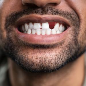 Лекарство за възстановяване на зъби ще бъде тествано върху хора за първи път