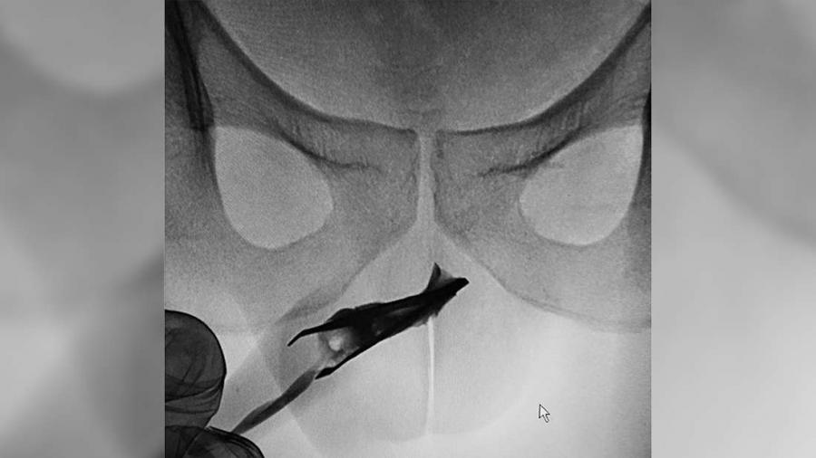 Мъж заклещи метални пинцети в своя пенис и не посети лекар в продължение на 4 години