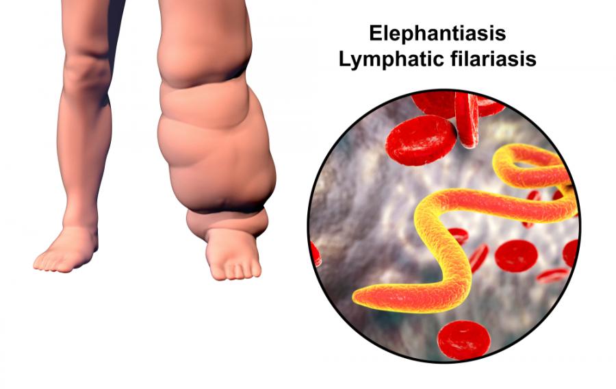 Чували ли сте за елефантиаза, по-известна като „слонска болест“?