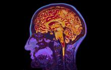 Американският регулатор одобри лекарство за ранните симптоми на Алцхаймер